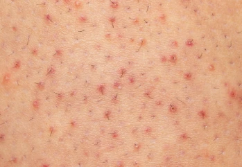 Ciltte Tavuk Derisi Hastalığı Nedir? Keratosis Pilaris Nasıl Geçer?